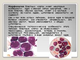 Лимфобластный лейкоз, слайд 6