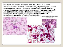 Лимфобластный лейкоз, слайд 7