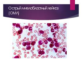 Острый миелобластный лейкоз (ОМЛ), слайд 3